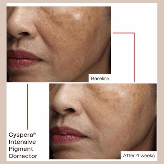 Intensive Pigment Corrector, Original Formula | Reduces Discoloration, Dark Spots | Contains Niacinamide, 5% Cysteamine | Dermatologist-tested, Vegan, Cruelty-Free, 1.75 Ounce