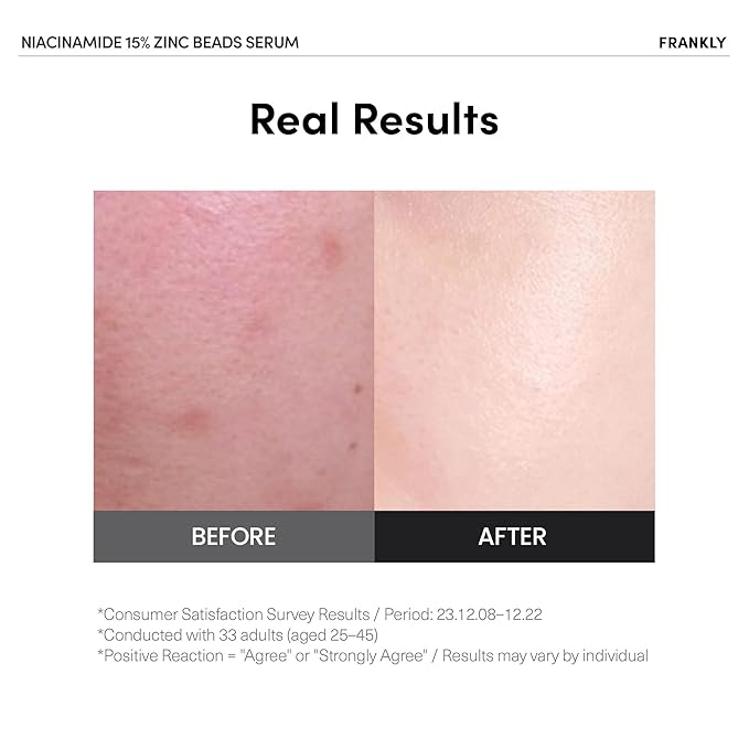FRANKLY Niacinamide 15% + Zinc Bead Serum Jumbo | High-Dose Yet Gentle Skin Repair | Acne, Pore & Redness Control | Bead-to-Skin Delivery System for Fresh Niacinamide | Korean Skincare | 2.02 fl.oz