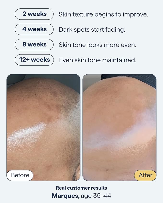 Remedy for Dark Spots | Advanced Night Treatment with Retinol & Kojic Acid | For Discoloration and Uneven Tones | With Glutathione, Niacinamide, Mandelic Acid | By Dermatologist Dr. Shah, 1 fl. oz
