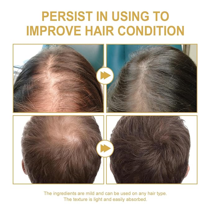 180 ML EELHOE Hair Growth Oil, Natural Rosemary Hair Growth Oil for Dry Damaged Hair and Growth Thin Hair. (3Pcs)