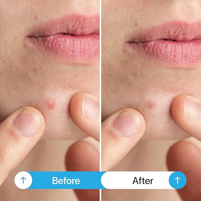Pimple Patches (102 Count) – Ultra-Thin Hydrocolloid Acne Patches for Face & Skin, Invisible Zit Stickers for Blemishes & Breakouts, Spot Treatment Dots, Vegan & Cruelty-Free Skincare