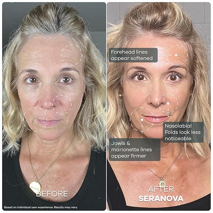 Seranova Micro Infusion System for Face & Neck 0.05mm Stamp with Hyaluronic Acid & Collagen Peptide Serum for Firmer Smoother-Looking Skin, Easy 5-Minute At-Home Skin Care Application - 3 Month Supply